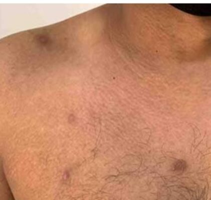 751. Zmałpowana ospa